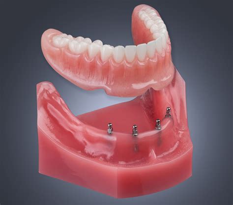 mini dental implant systems